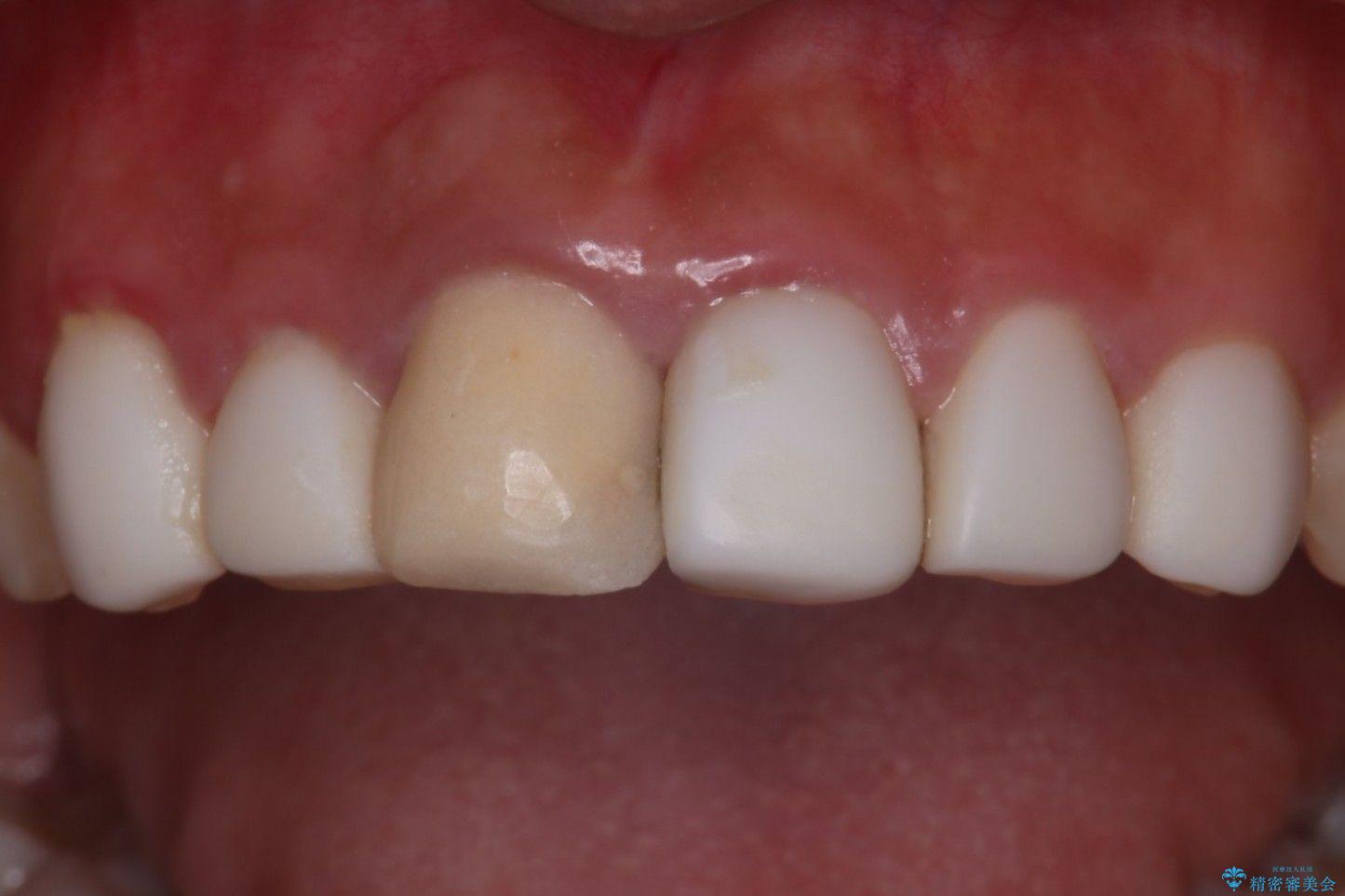 オールセラミッククラウンで歯の色を合わせたい 治療前