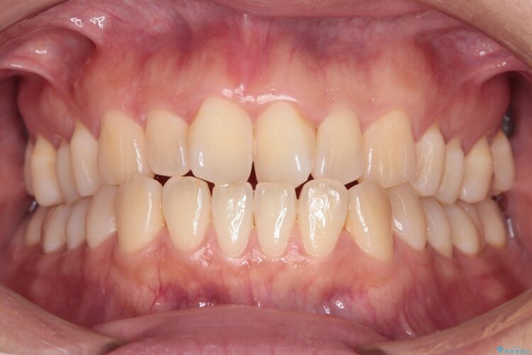 気になる前歯のねじれをインビザラインで改善 治療前画像