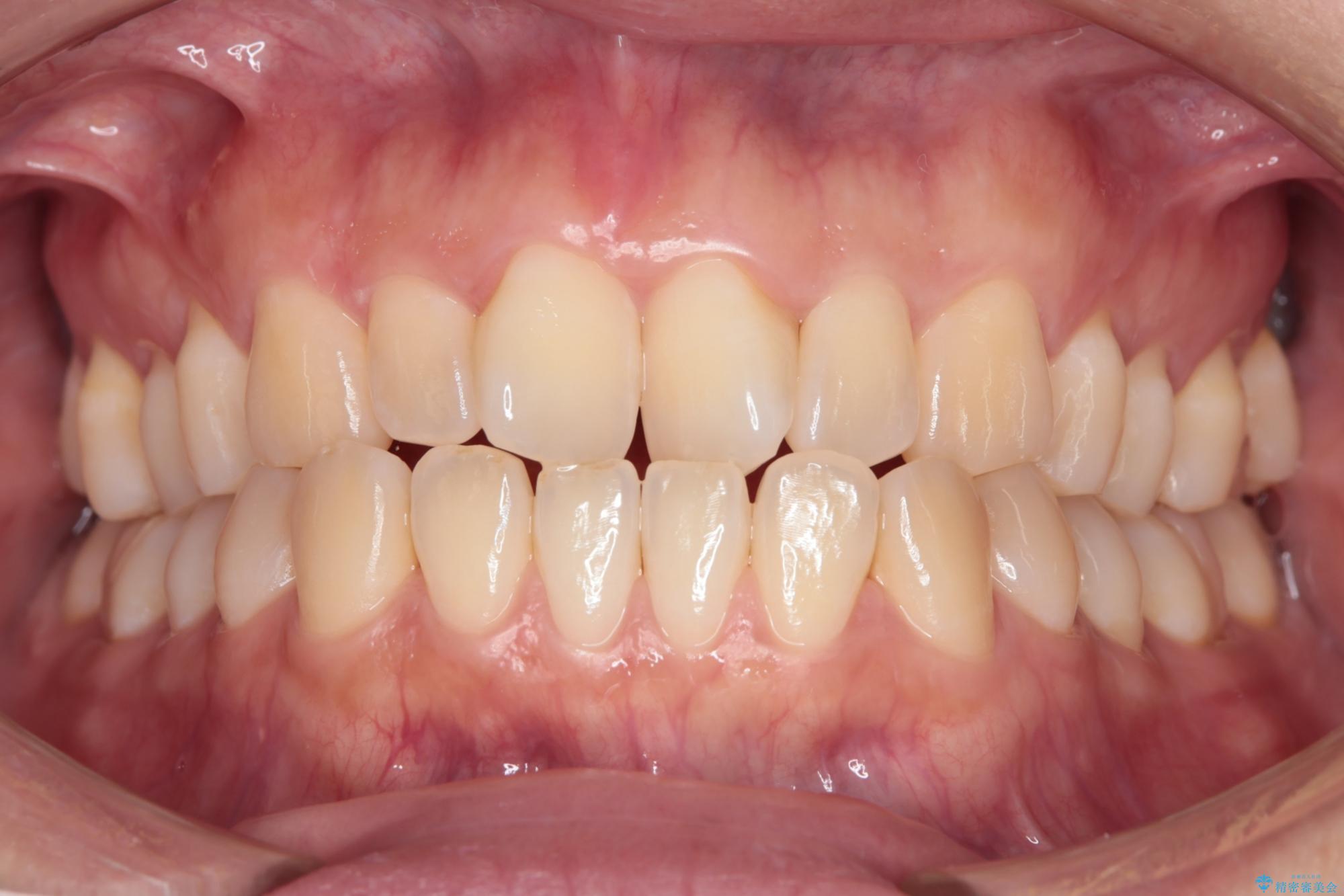 気になる前歯のねじれをインビザラインで改善 治療前