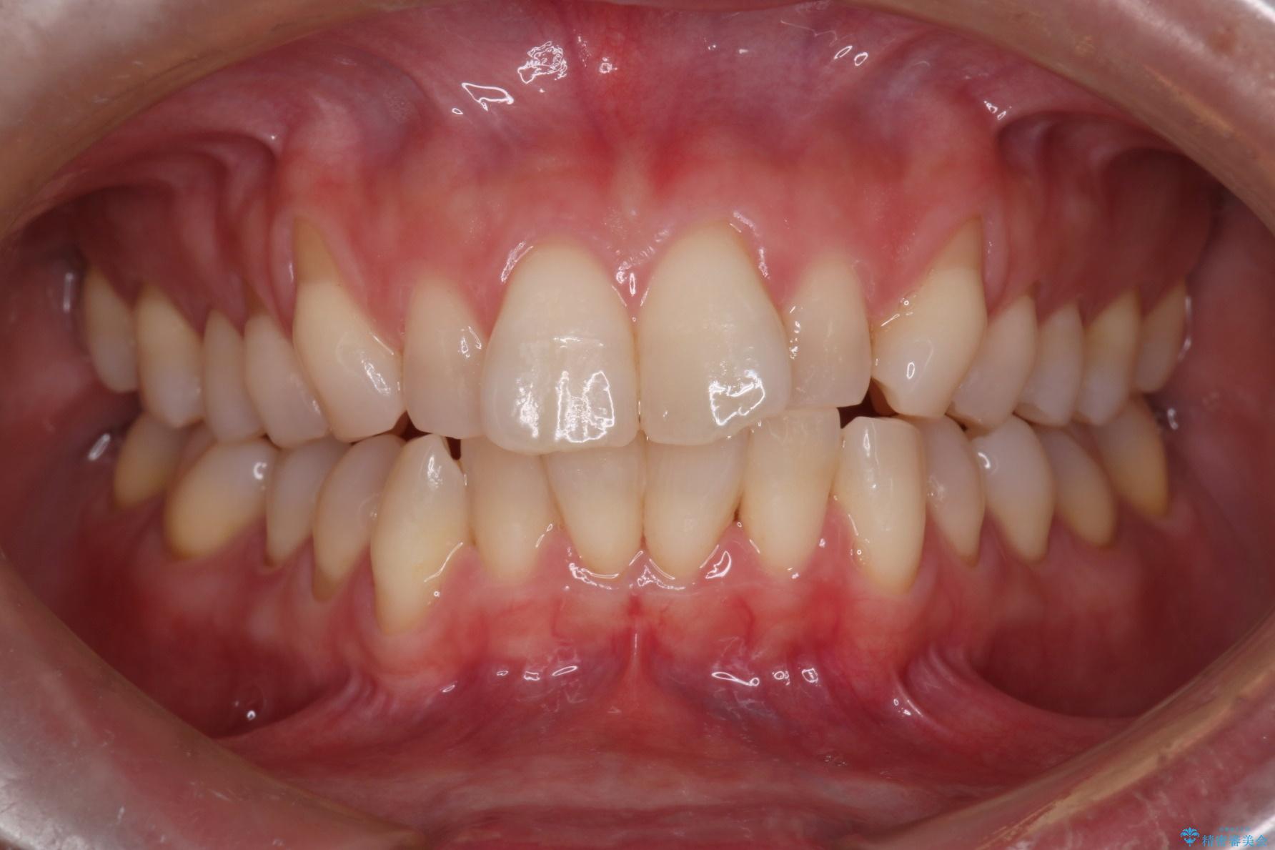 気になる出っ歯とガタつきの改善 治療前