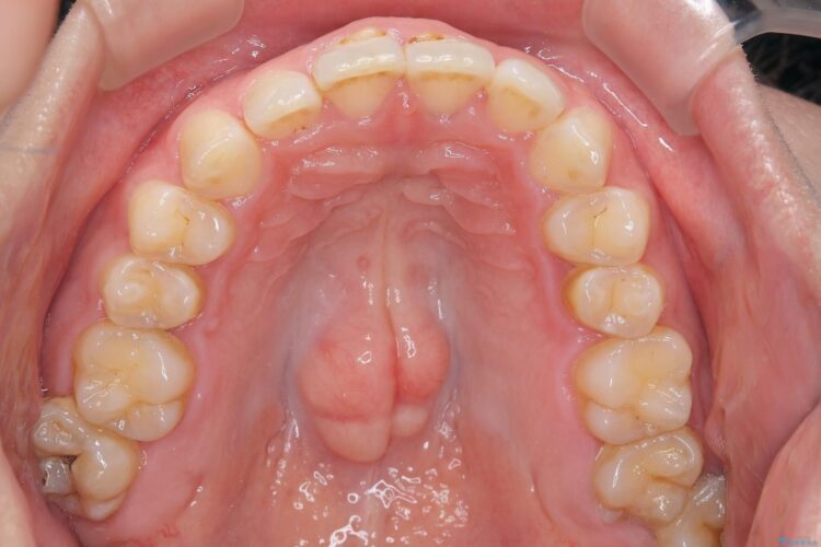 コンビネーション矯正でがたつきと噛み合わせを改善 治療前画像