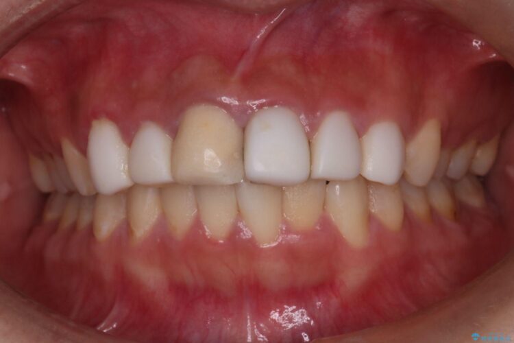 オールセラミッククラウンで歯の色を合わせたい 治療前画像