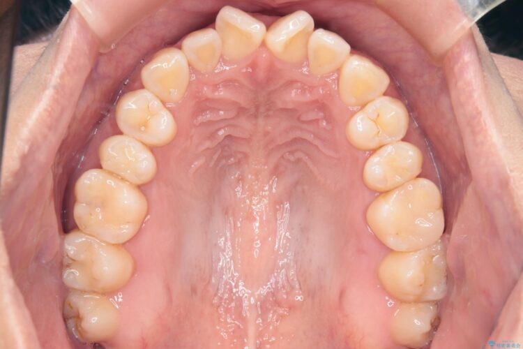 気になる前歯のねじれをインビザラインで改善 治療前画像