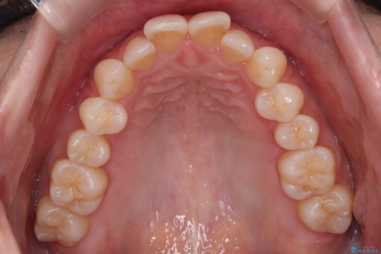 気になる出っ歯とガタつきの改善 治療前画像
