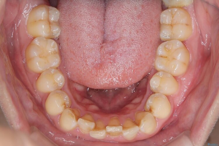 コンビネーション矯正でがたつきと噛み合わせを改善 治療前画像