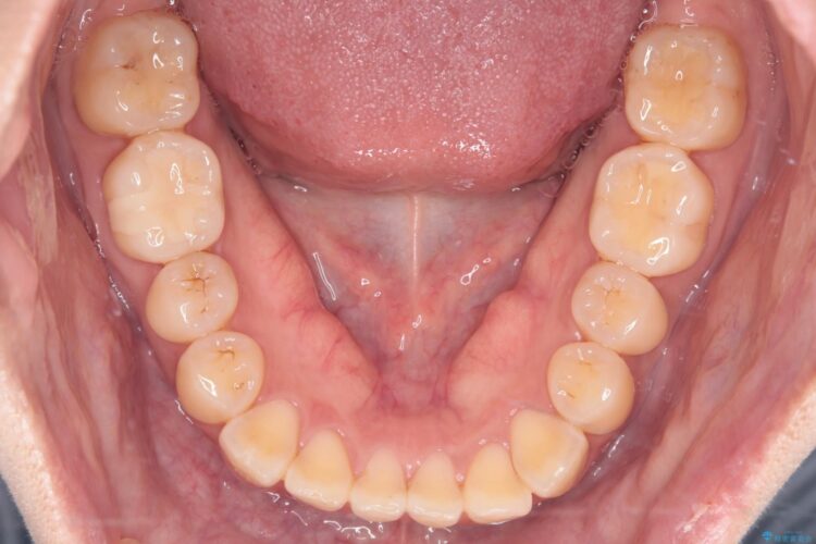 気になる前歯のねじれをインビザラインで改善 治療前画像