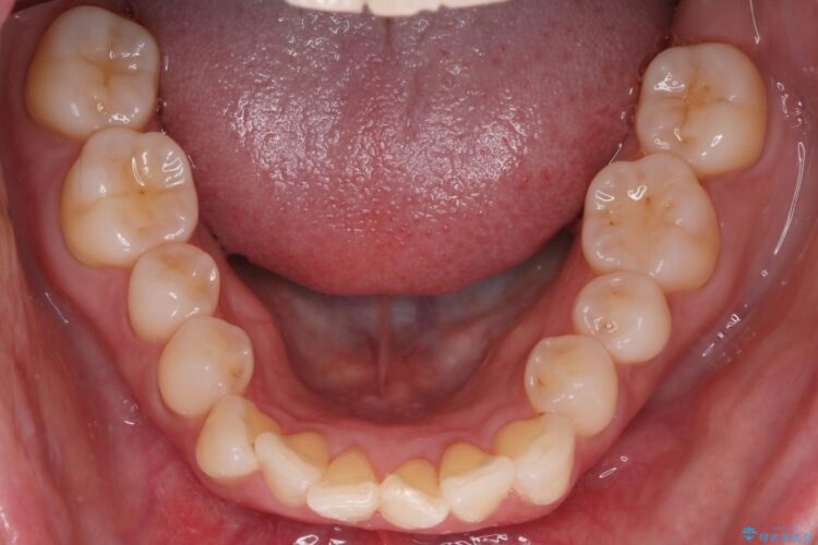 気になる出っ歯とガタつきの改善 治療前画像