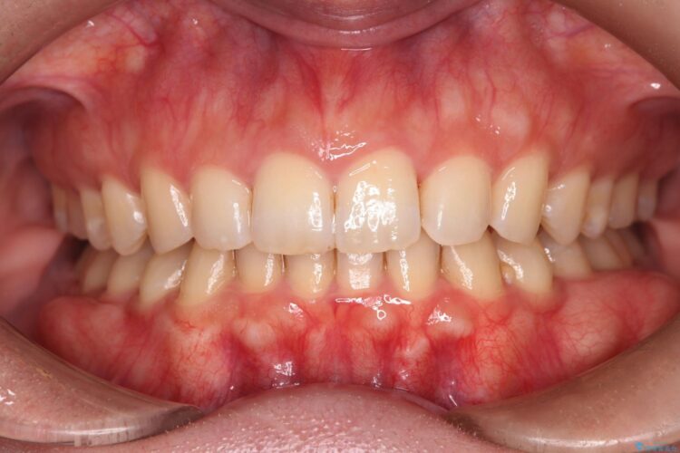 コンビネーション矯正でがたつきと噛み合わせを改善 治療後画像