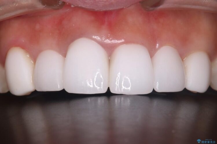 オールセラミッククラウンで歯の色を合わせたい 治療後画像