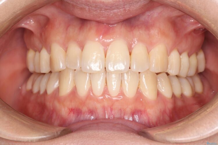 気になる前歯のねじれをインビザラインで改善 治療後画像