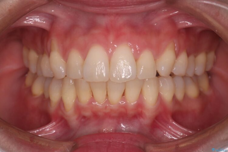 気になる出っ歯とガタつきの改善 治療後画像
