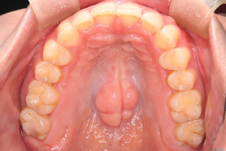 コンビネーション矯正でがたつきと噛み合わせを改善 治療後画像