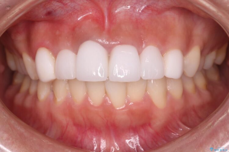 オールセラミッククラウンで歯の色を合わせたい 治療後画像