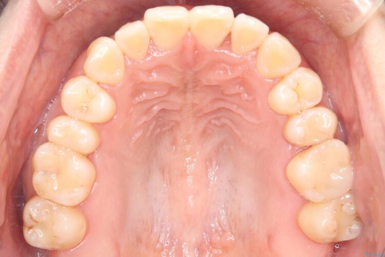 気になる前歯のねじれをインビザラインで改善 治療後画像