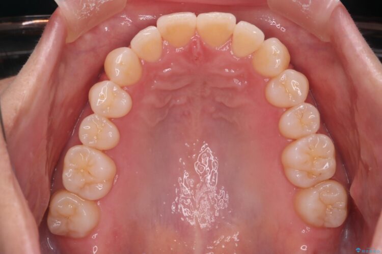 気になる出っ歯とガタつきの改善 治療後画像