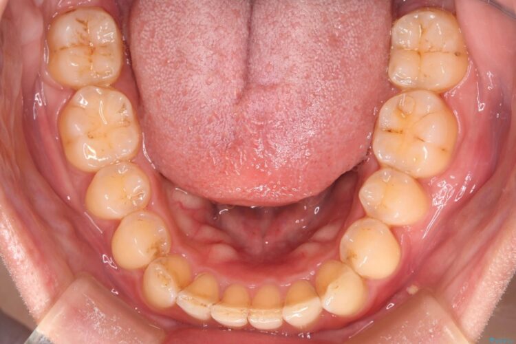 コンビネーション矯正でがたつきと噛み合わせを改善 治療後画像