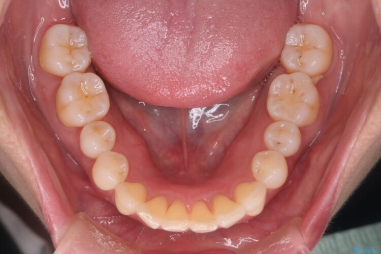 気になる出っ歯とガタつきの改善 治療後画像