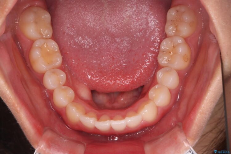 インビザラインで前歯のガタつきを綺麗に 治療後画像