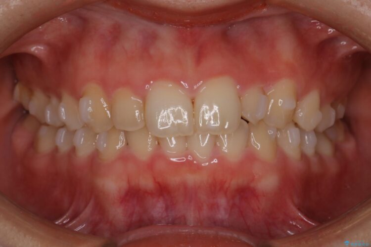 インビザラインで前歯のガタつきを綺麗に 治療途中画像