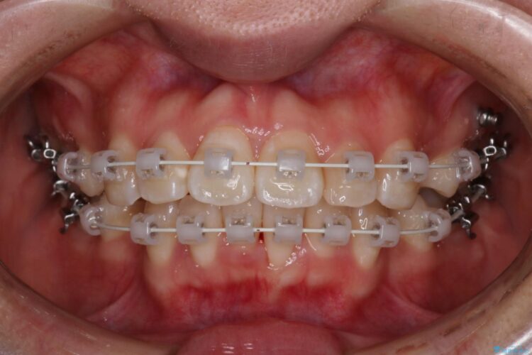 抜歯矯正で口元を下げる 治療途中画像