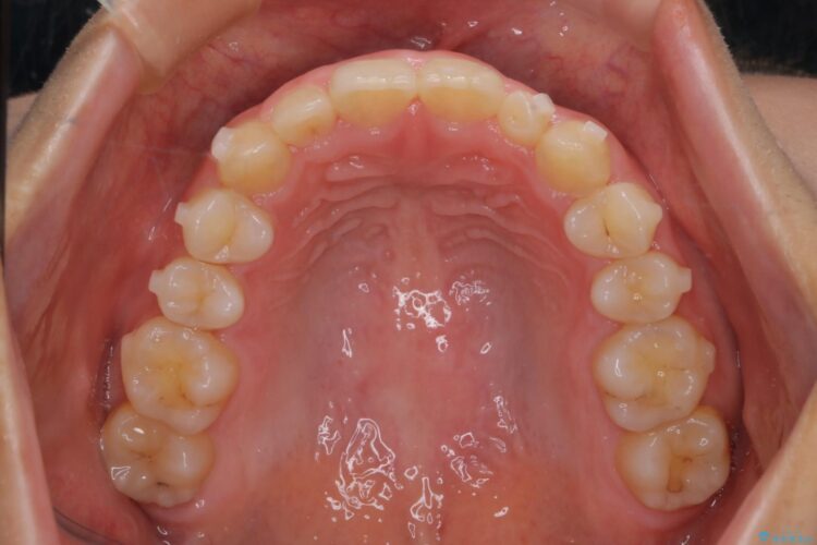 インビザラインで前歯のガタつきを綺麗に 治療途中画像