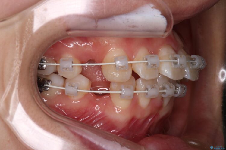 抜歯矯正で口元を下げる 治療途中画像