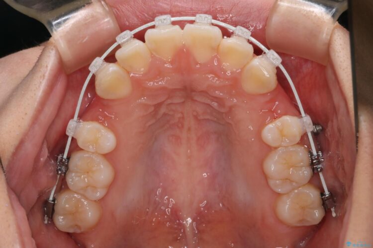 抜歯矯正で口元を下げる 治療途中画像