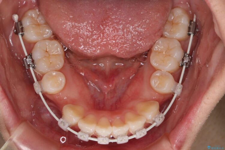 抜歯矯正で口元を下げる 治療途中画像