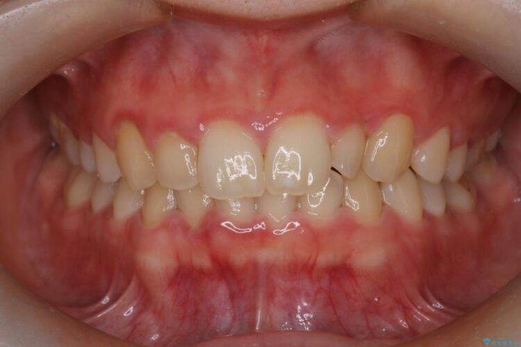 インビザラインで前歯のガタつきを綺麗に ビフォー