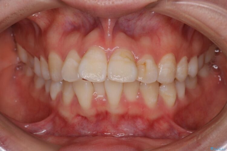 抜歯矯正で口元を下げる ビフォー