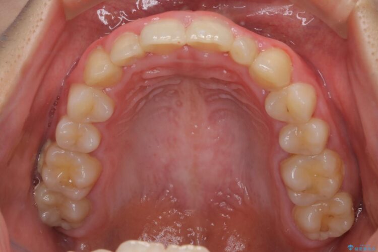 インビザラインで前歯のガタつきを綺麗に 治療前画像