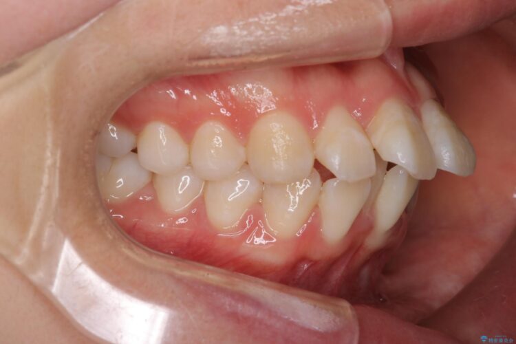 抜歯矯正で口元を下げる 治療前画像