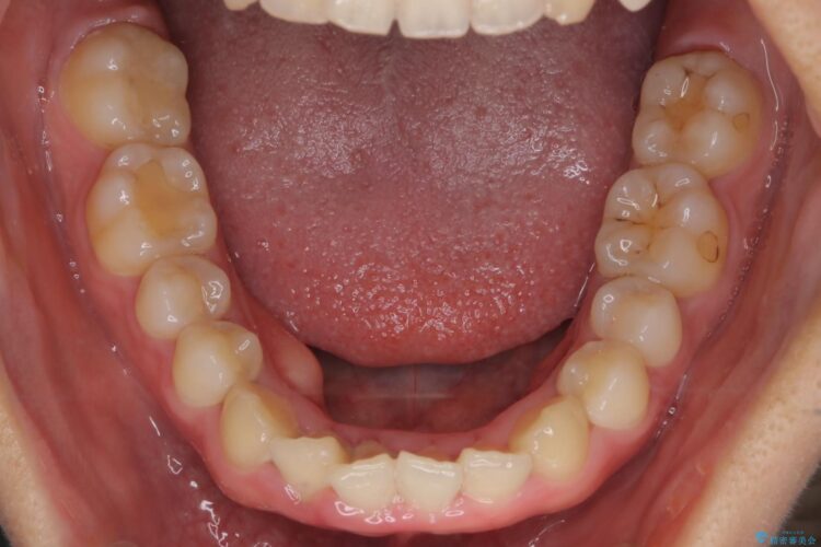 インビザラインで前歯のガタつきを綺麗に 治療前画像