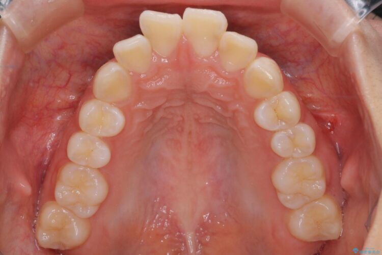 抜歯矯正で口元を下げる 治療前画像