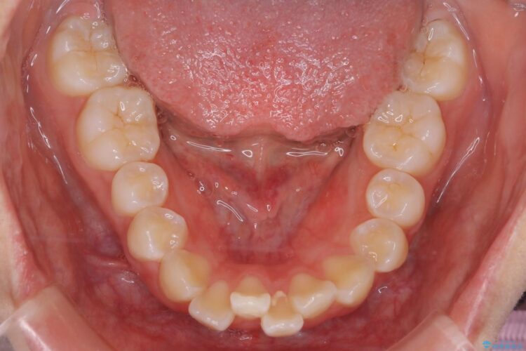 抜歯矯正で口元を下げる 治療前画像