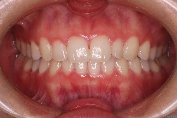 インビザラインで前歯のガタつきを綺麗に アフター