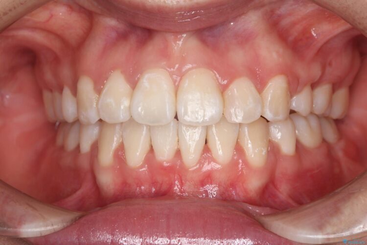 抜歯矯正で口元を下げる アフター