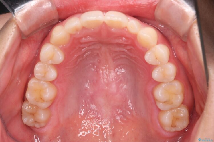 インビザラインで前歯のガタつきを綺麗に 治療後画像