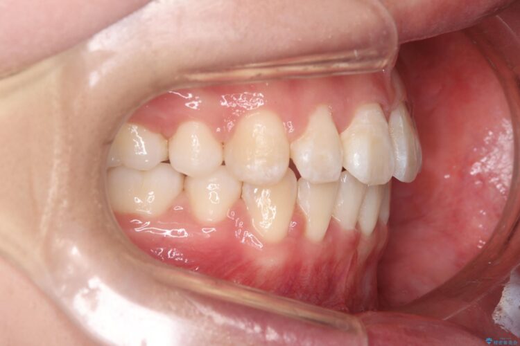 抜歯矯正で口元を下げる 治療後画像