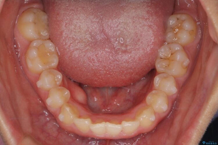 インビザラインで前歯のガタつきを綺麗に 治療途中画像