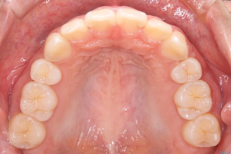 抜歯矯正で口元を下げる 治療後画像