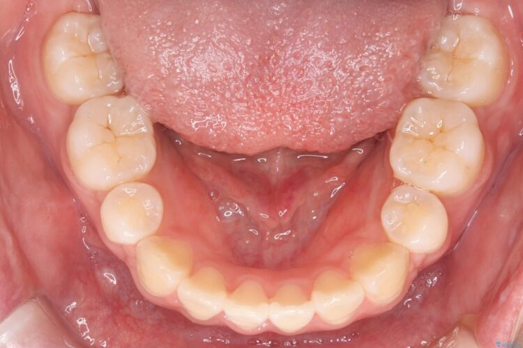 抜歯矯正で口元を下げる 治療後画像