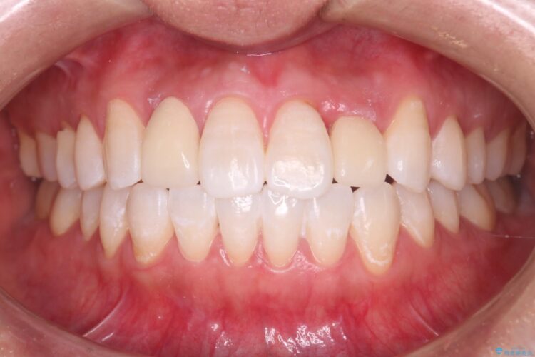 セラミック治療前にホワイトニング アフター