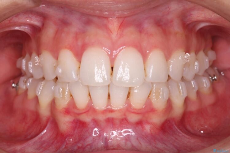 突出した前歯をインビザラインで改善 治療途中画像