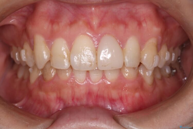 インビザラインとセラミックで前歯を美しく 治療途中画像