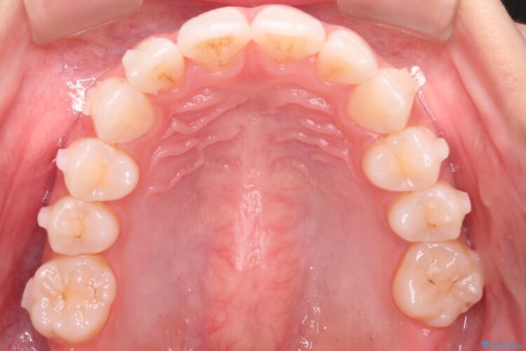 突出した前歯をインビザラインで改善 治療途中画像