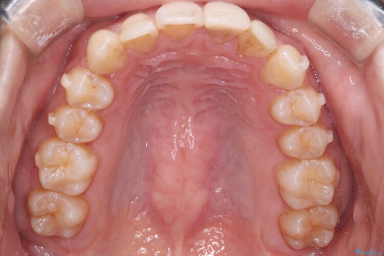 インビザラインとセラミックで前歯を美しく 治療途中画像