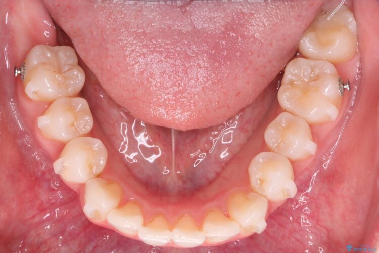 突出した前歯をインビザラインで改善 治療途中画像