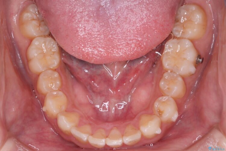 インビザラインとセラミックで前歯を美しく 治療途中画像