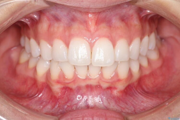 突出した前歯をインビザラインで改善 ビフォー